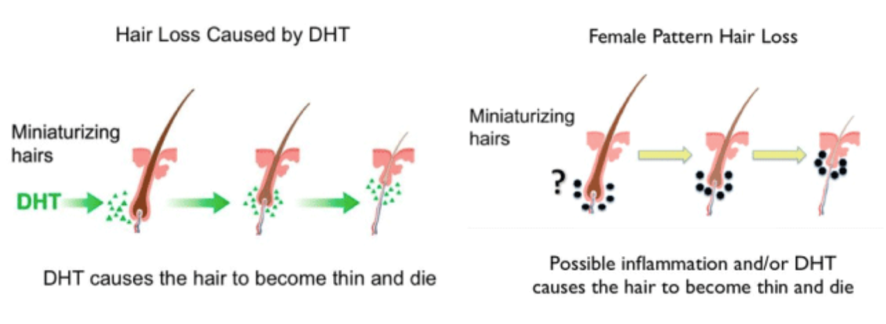 The Perils of High DHT and Hair Loss – P1Health