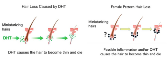 The Perils of High DHT and Hair Loss